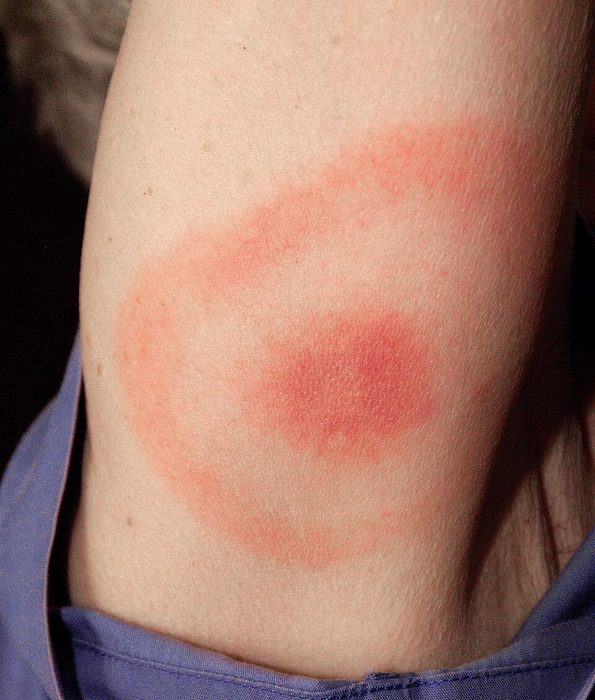Erythema migrans rash on a person's upper arm, showing an expanding red ring around a central red patch